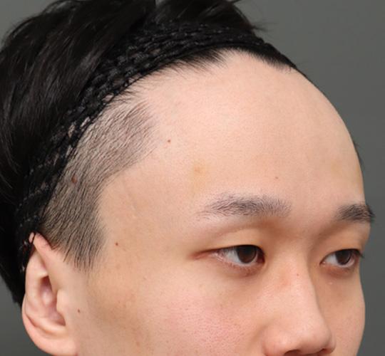 20代男性の額縮小 Before 症例写真