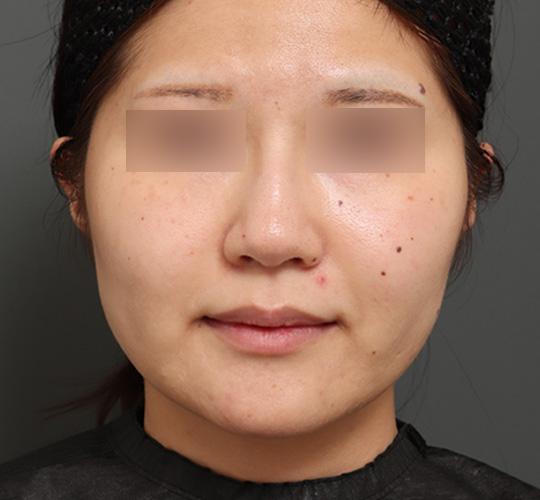 20代女性の顔の脂肪吸引  After 症例写真