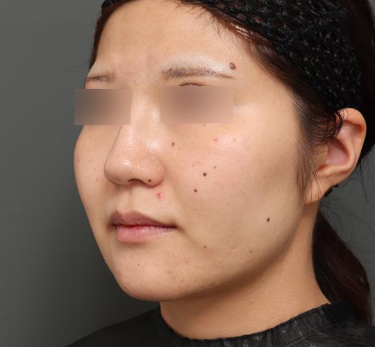 20代女性の顔の脂肪吸引  After 症例写真