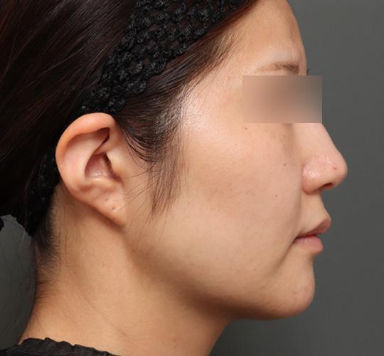 20代女性の顔の脂肪吸引  After 症例写真
