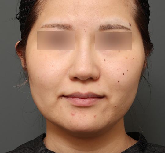 20代女性の顔の脂肪吸引  Before 症例写真