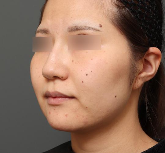 20代女性の顔の脂肪吸引  Before 症例写真