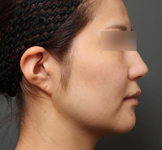 20代女性の顔の脂肪吸引  Before 症例写真