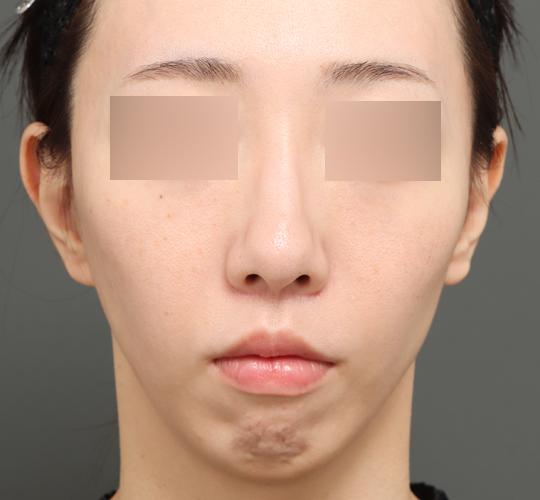 30代女性の人中短縮（リップリフト） After 症例写真