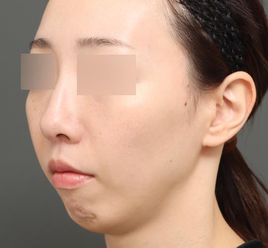 30代女性の人中短縮（リップリフト） After 症例写真