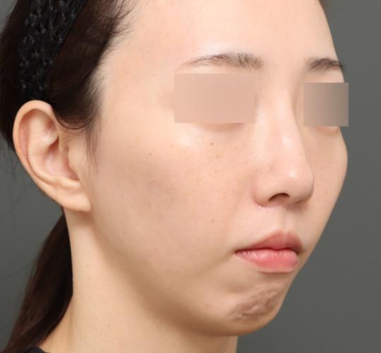 30代女性の人中短縮（リップリフト） After 症例写真