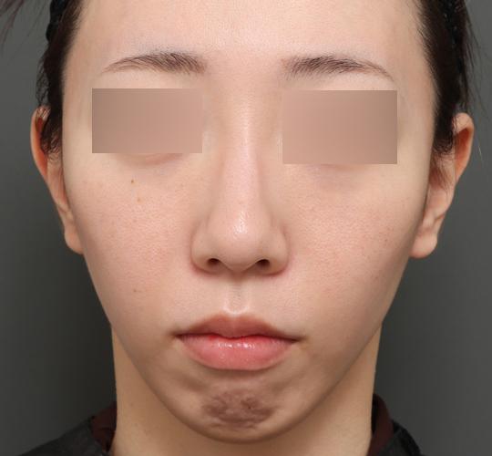 30代女性の人中短縮（リップリフト） Before 症例写真