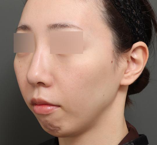 30代女性の人中短縮（リップリフト） Before 症例写真