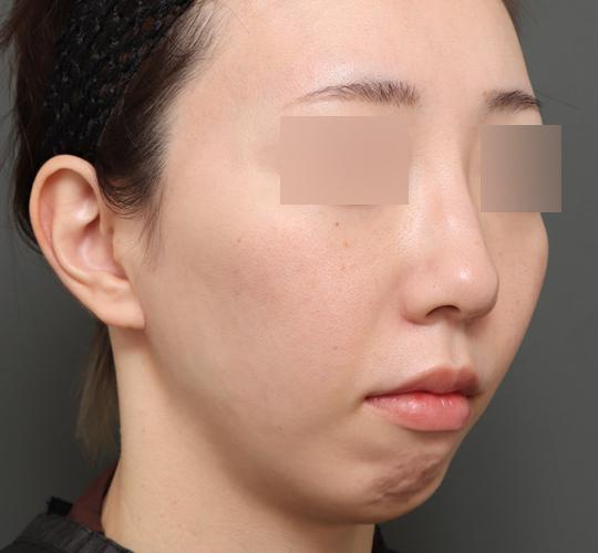 30代女性の人中短縮（リップリフト） Before 症例写真