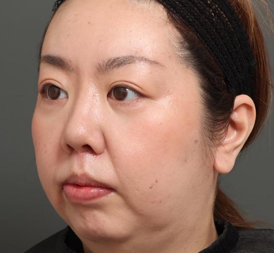 30代女性の人中短縮(リップリフト) After 症例写真