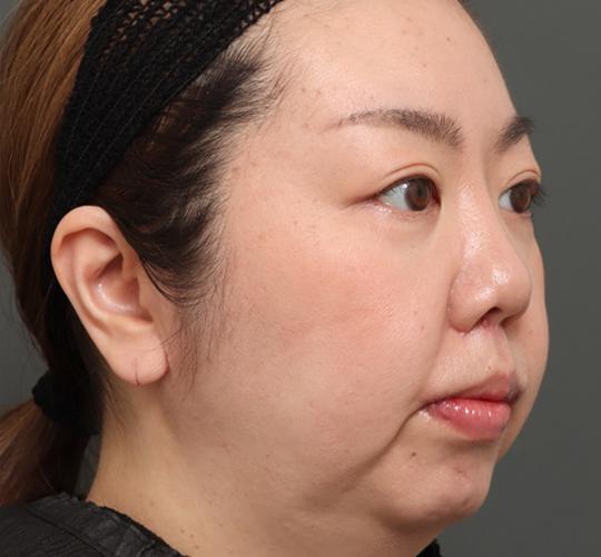 30代女性の人中短縮(リップリフト) After 症例写真