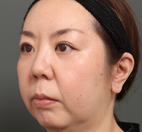 30代女性の人中短縮(リップリフト) Before 症例写真