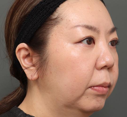 30代女性の人中短縮(リップリフト) Before 症例写真