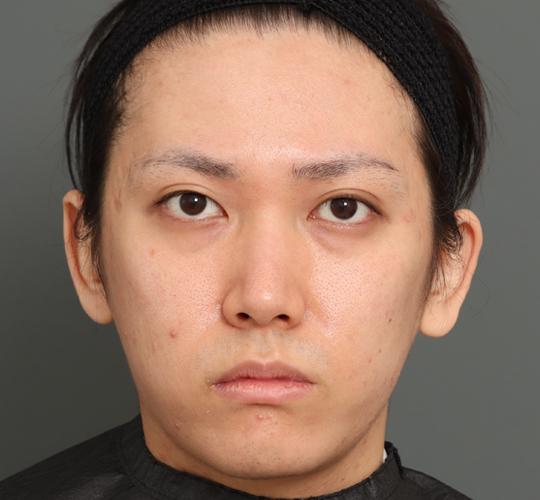 20代男性の顔の脂肪吸引 After 症例写真