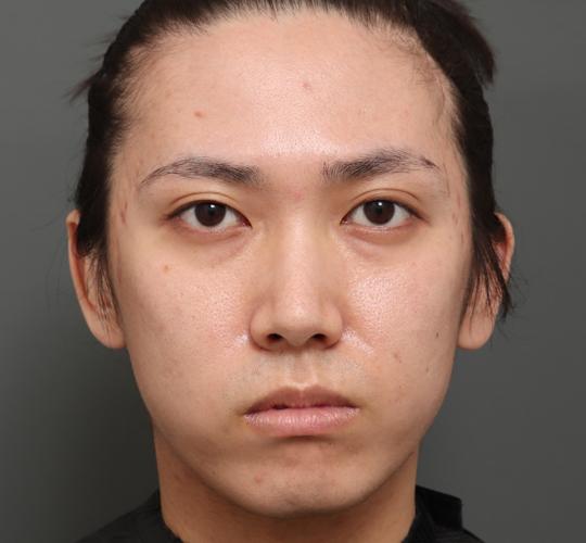 20代男性の顔の脂肪吸引 Before 症例写真