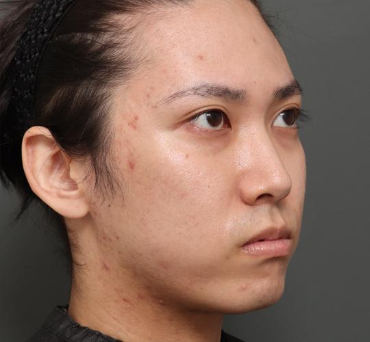 20代男性の顔の脂肪吸引  Before 症例写真