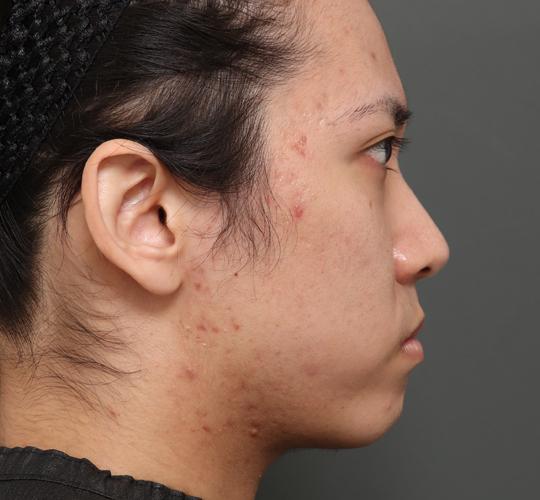 20代男性の顔の脂肪吸引  Before 症例写真
