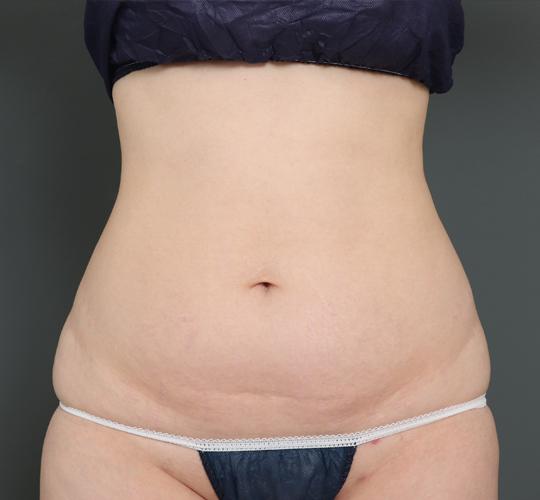30代女性の脂肪吸引・痩身 Before 症例写真