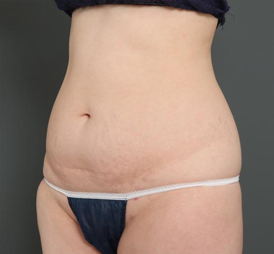 30代女性の外薗式タミータック(腹壁形成術) Before 症例写真