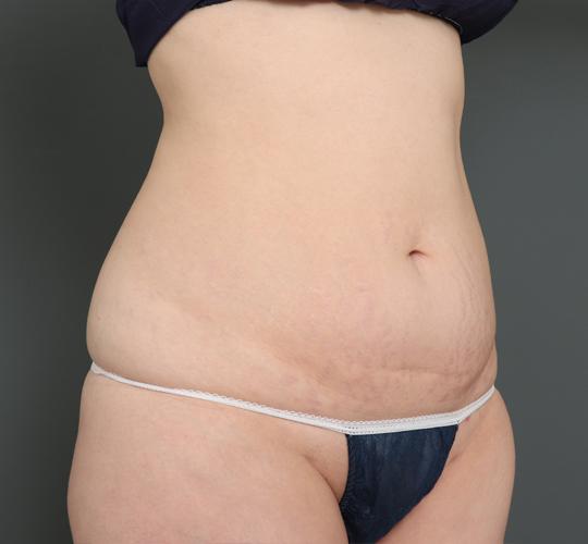 30代女性の外薗式タミータック(腹壁形成術) Before 症例写真