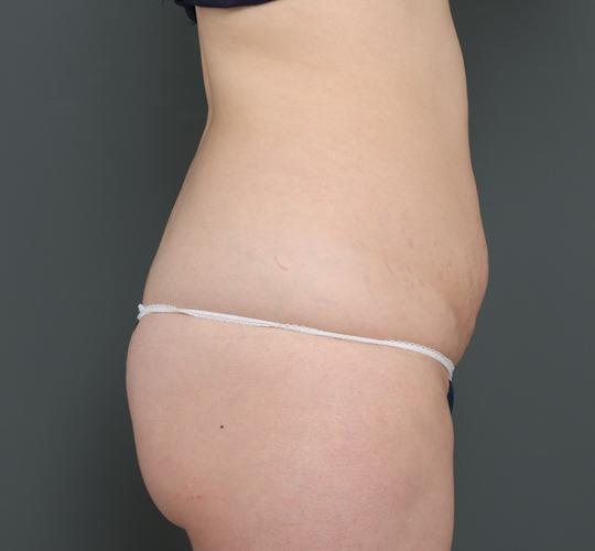 30代女性の外薗式タミータック(腹壁形成術) Before 症例写真