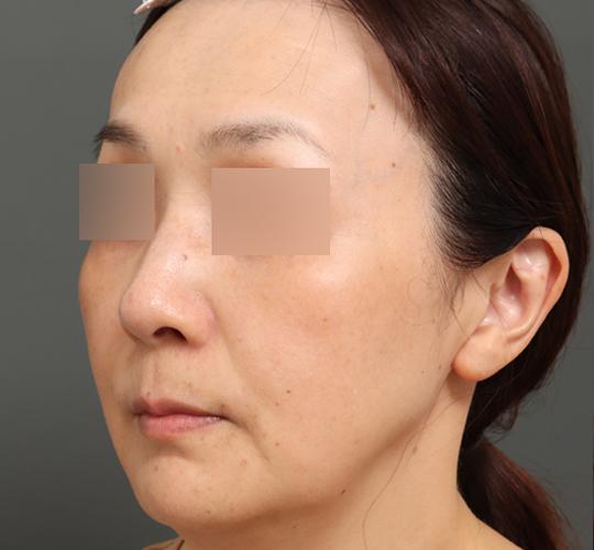 40代女性のボルニューマー After 症例写真