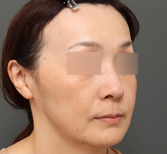 40代女性のボルニューマー After 症例写真