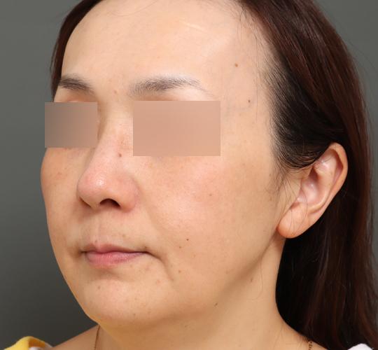 40代女性のボルニューマー Before 症例写真