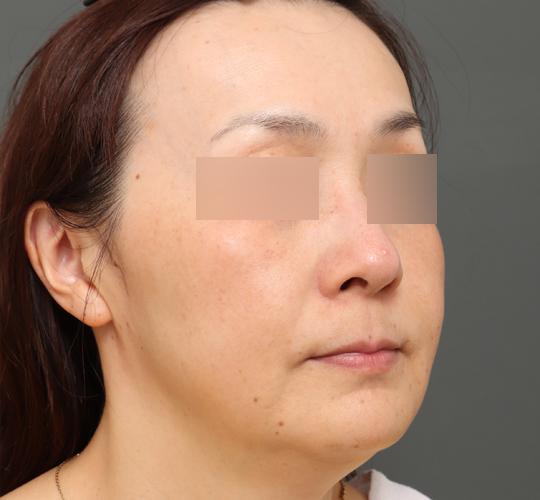 40代女性のボルニューマー Before 症例写真