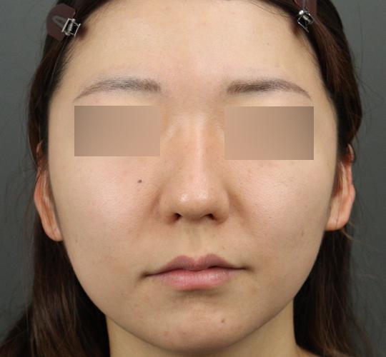20代女性の毛穴・黒ずみ After 症例写真