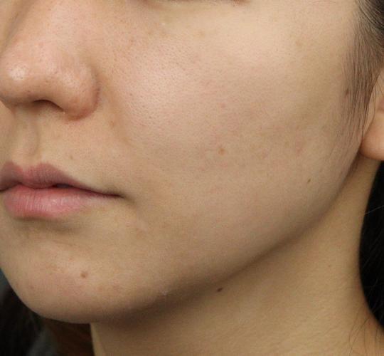 20代女性の肌管理毛穴スリークスキン（ダーマペン4） After 症例写真