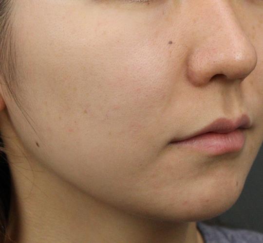 20代女性の肌管理毛穴スリークスキン（ダーマペン4） After 症例写真