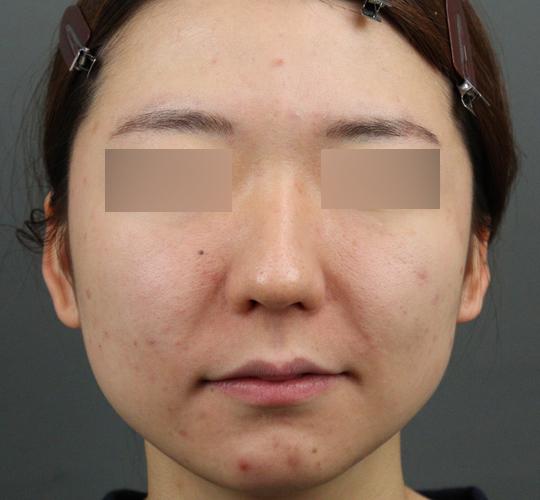 20代女性の毛穴・黒ずみ Before 症例写真