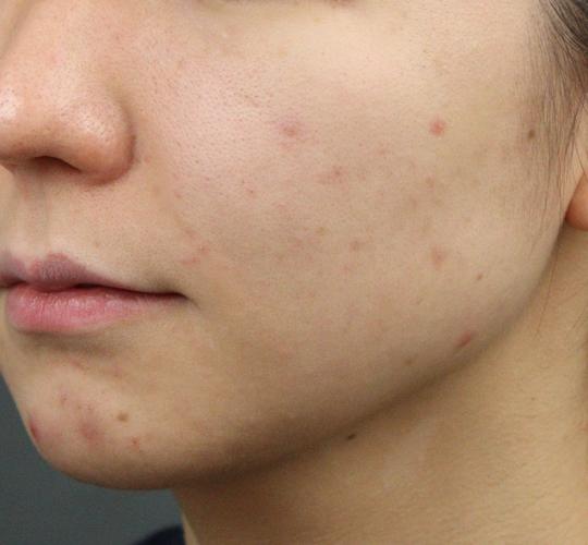 20代女性の肌管理毛穴スリークスキン（ダーマペン4） Before 症例写真