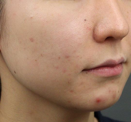 20代女性の肌管理毛穴スリークスキン（ダーマペン4） Before 症例写真