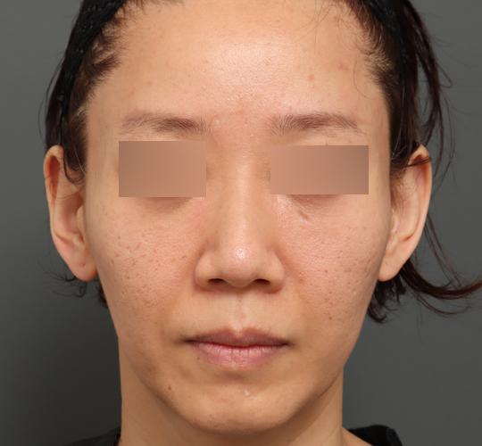 40代女性のボルニューマー After 症例写真