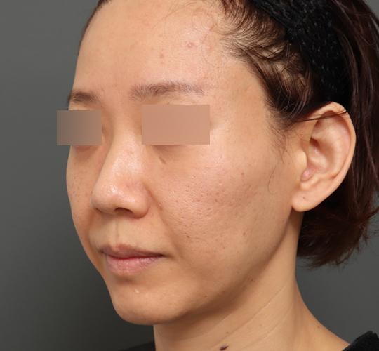 40代女性のボルニューマー After 症例写真