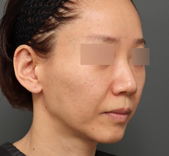 40代女性のボルニューマー After 症例写真