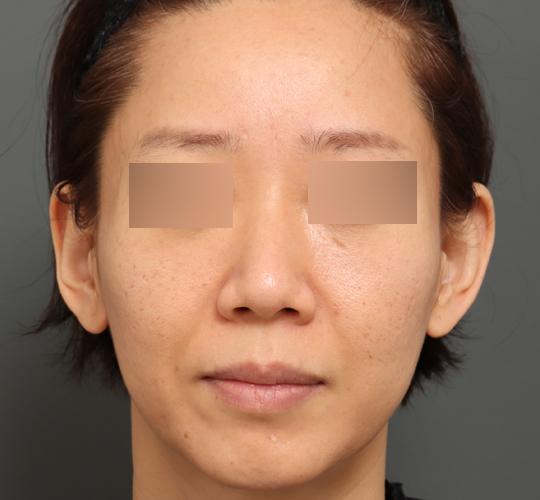 40代女性のボルニューマー Before 症例写真