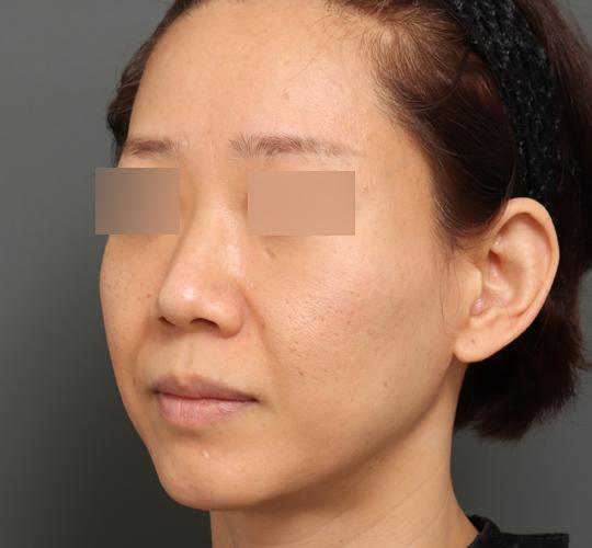 40代女性のボルニューマー Before 症例写真