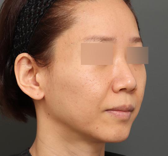 40代女性のボルニューマー Before 症例写真