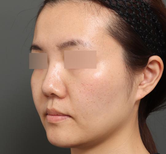 30代女性のボルニューマー After 症例写真