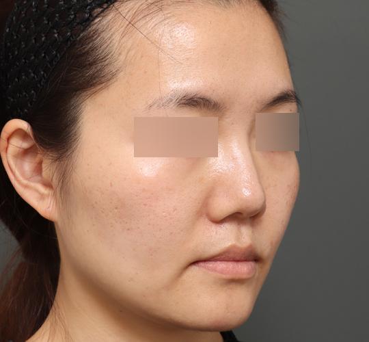 30代女性のボルニューマー After 症例写真