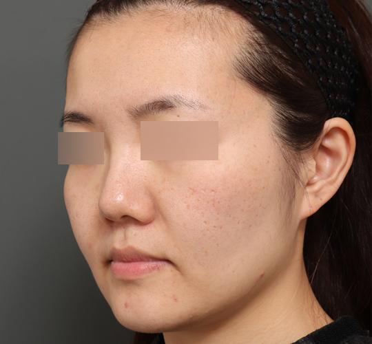 30代女性のボルニューマー Before 症例写真