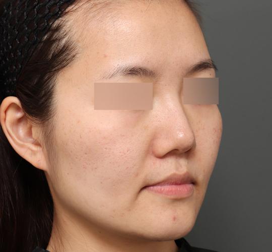 30代女性のボルニューマー Before 症例写真