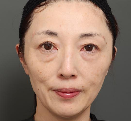 50代女性のボルニューマー After 症例写真