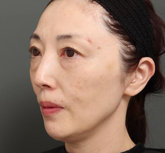 50代女性のエラ・アゴ・小顔 After 症例写真