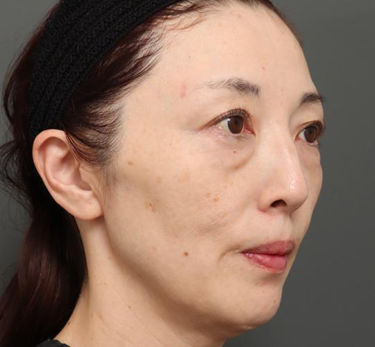 50代女性のボルニューマー After 症例写真