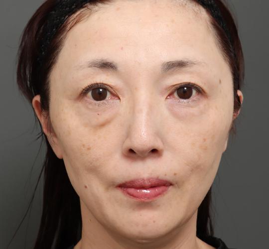 50代女性のボルニューマー Before 症例写真