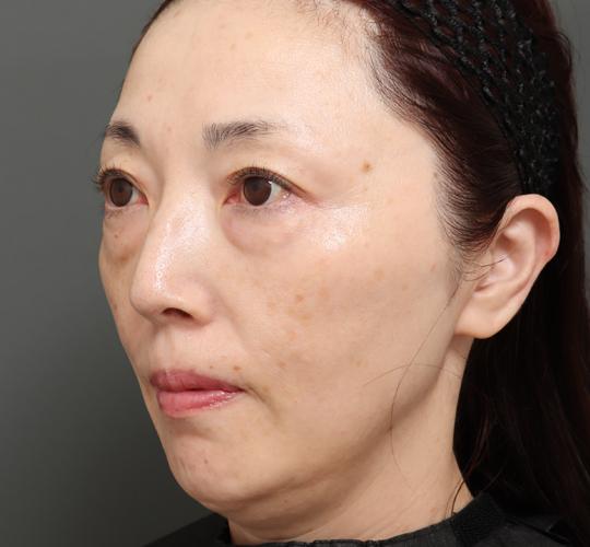 50代女性のエラ・アゴ・小顔 Before 症例写真